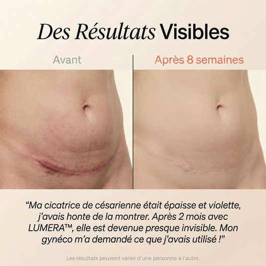 Lumera Pro™ – Adieu le Ventre Post-Partum